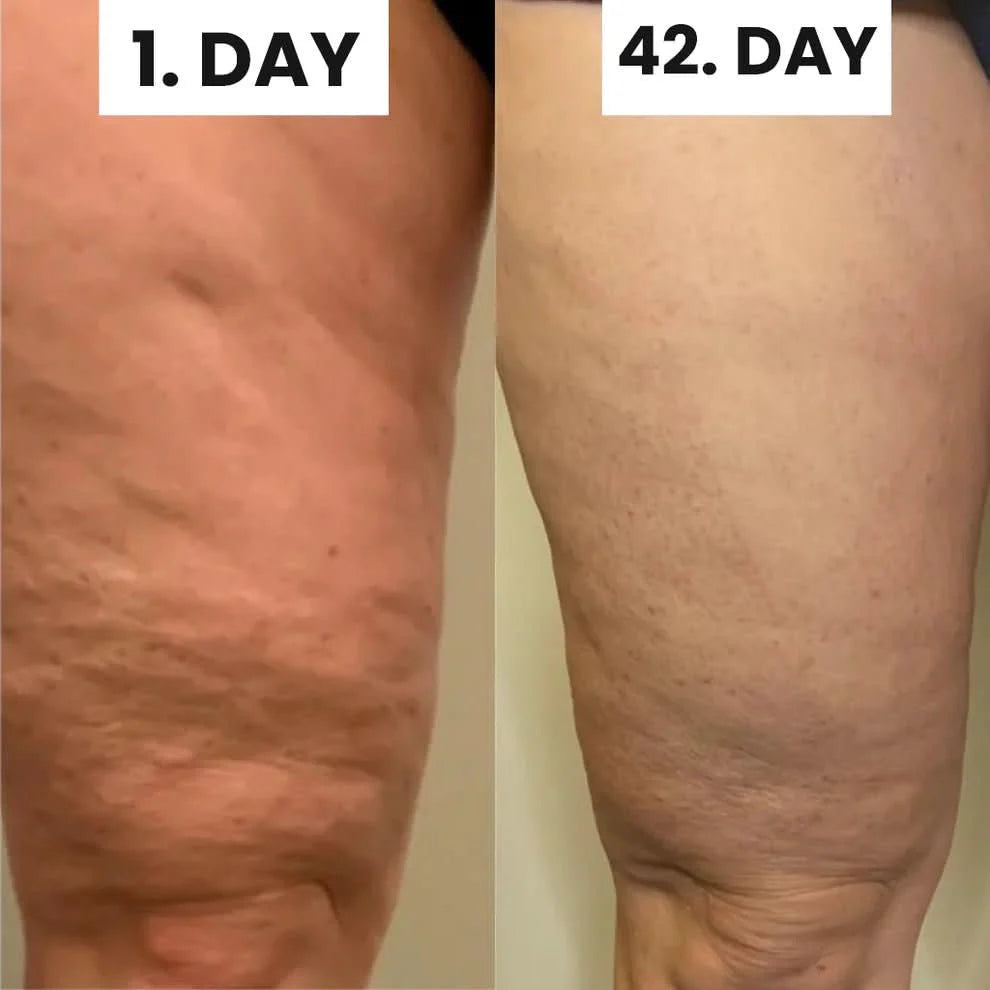 Glorace™ Cellulite Relief Kit